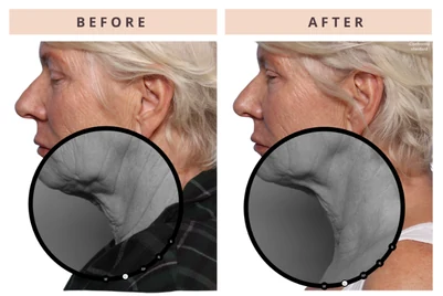 Neck before and after result