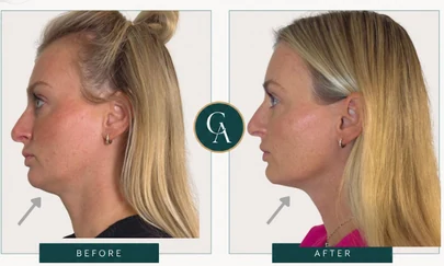Jawline before and after result