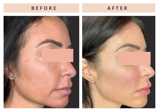Acne appearance before and after result