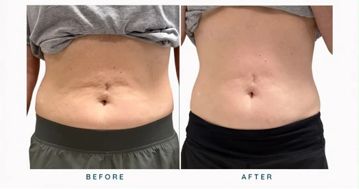 Abdomen before and after result