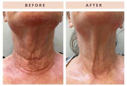 Neck before and after result