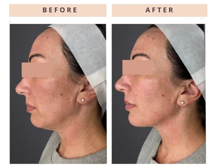 Facial profile before and after result