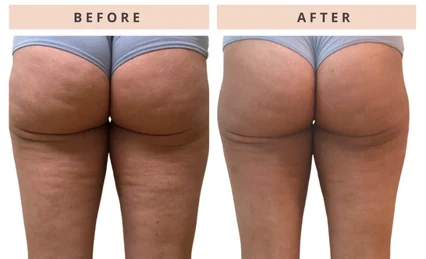 Cellulite appearance before and after result