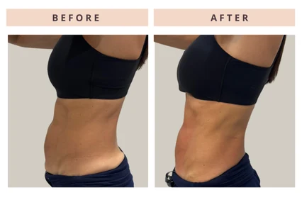 Abdomen before and after result