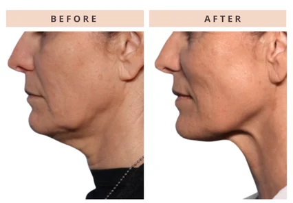 Jawline before and after result