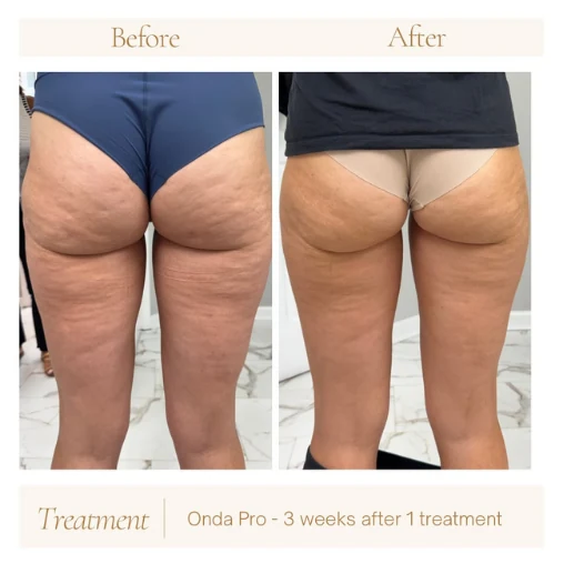 Cellulite appearance before and after result