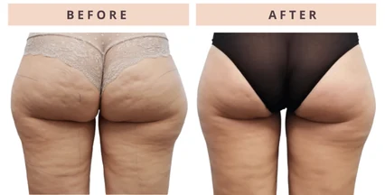 Cellulite appearance before and after result