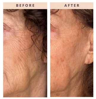 Facial skin before and after result
