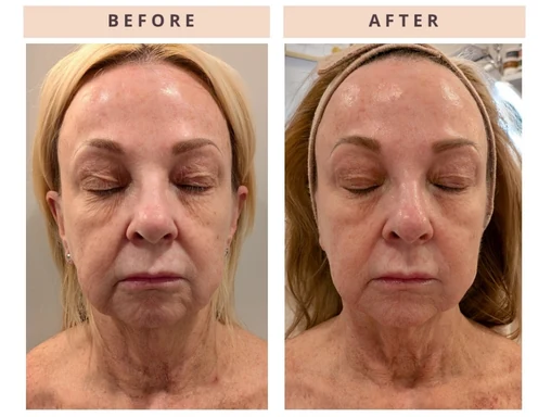 Facial skin before and after result