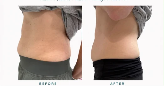 Abdomen before and after result