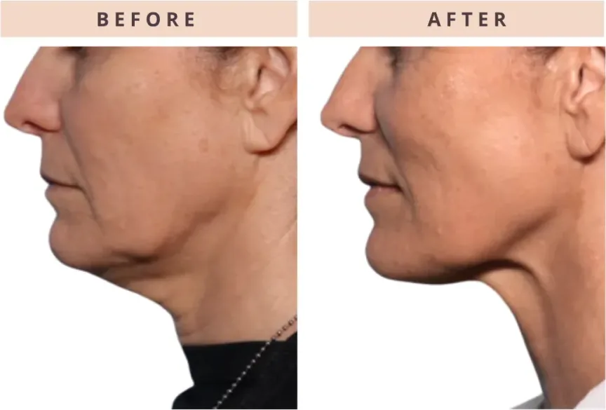 Jawline contouring before and after result