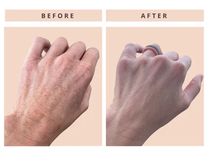 Hand skin before and after result