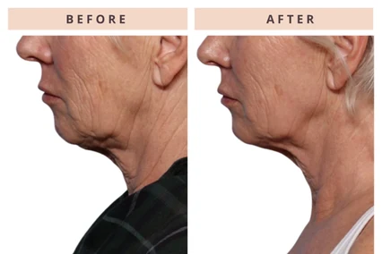 Neck before and after result