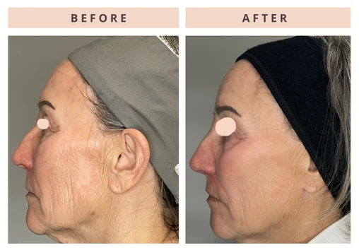 Facial profile before and after result