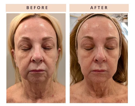 Face and neck before and after result