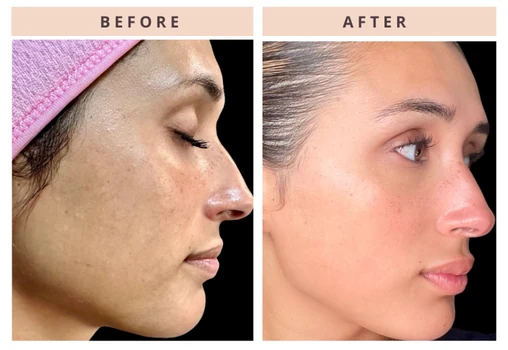 Facial profile before and after result