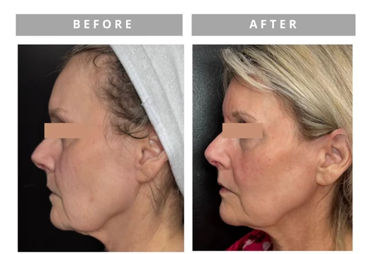 Facial profile before and after result