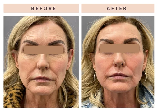 Face before and after result