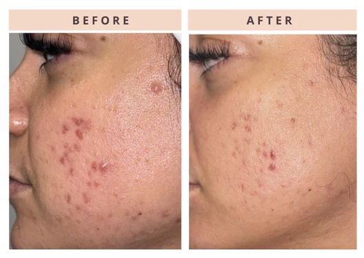 Facial skin before and after result