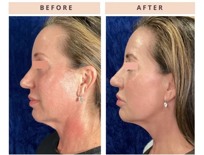 Facial profile before and after result
