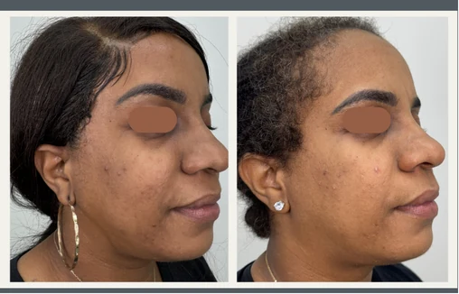Facial skin before and after result