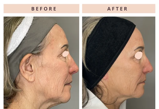 Facial profile before and after result